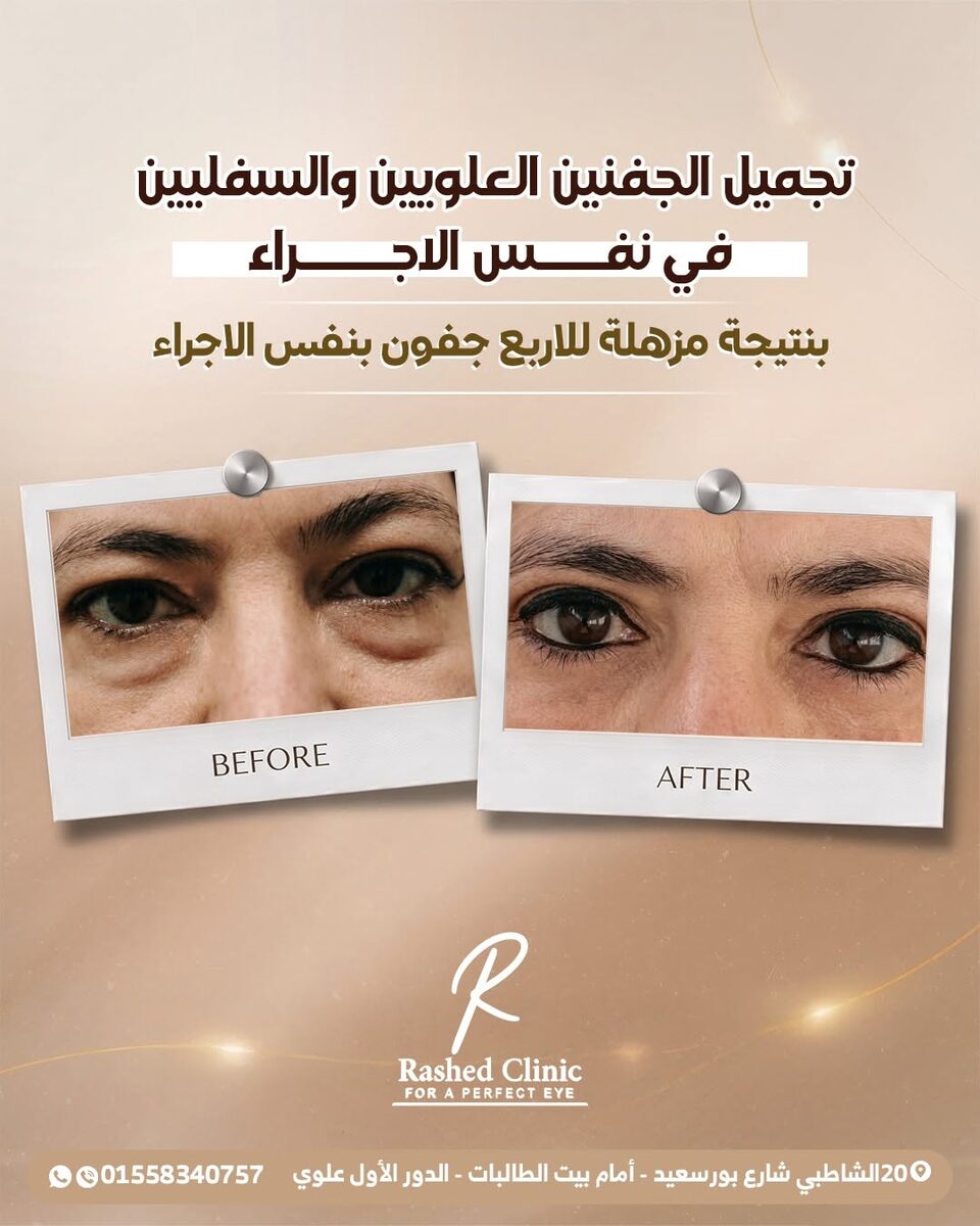 قبل وبعد: تجميل الجفون العلوية والسفلية