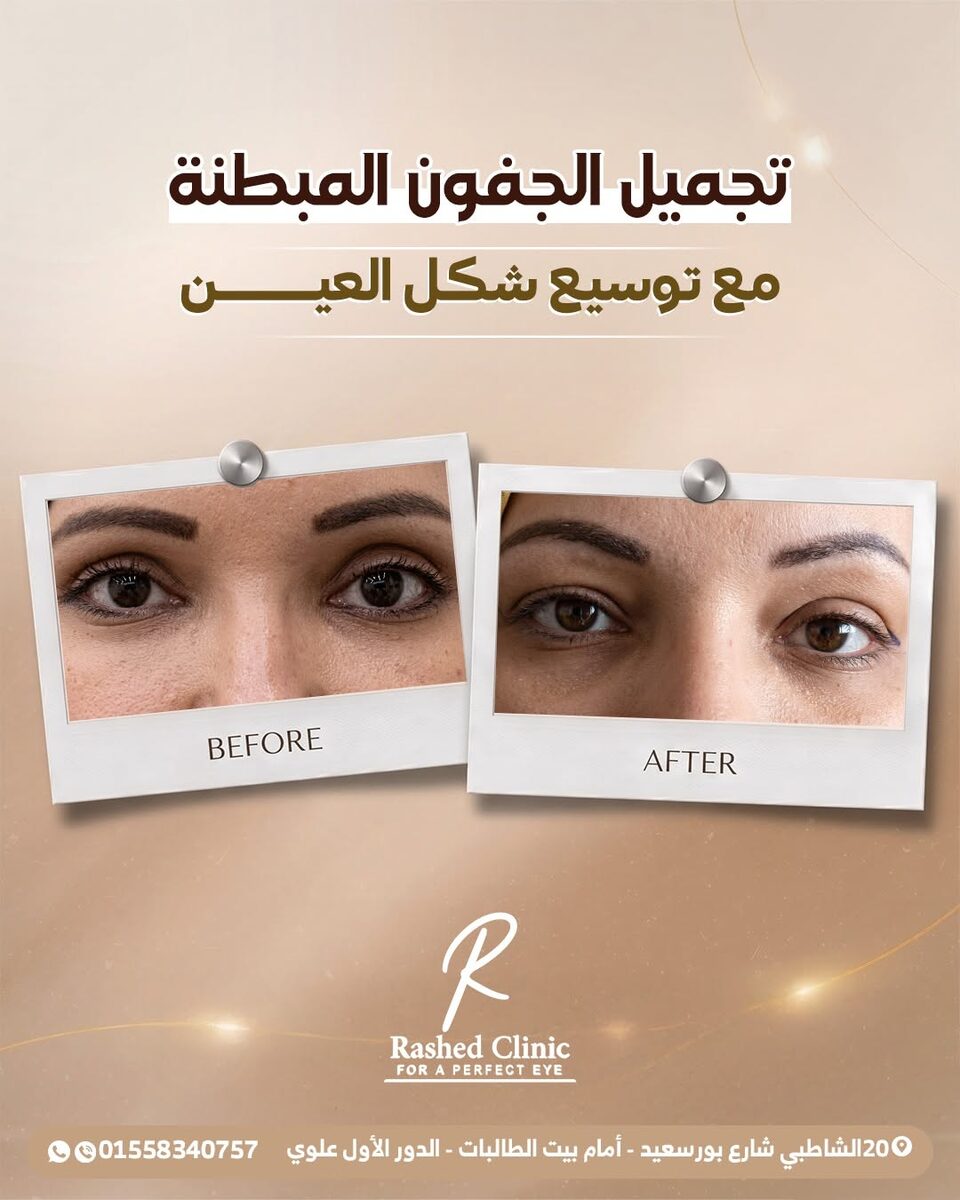قبل وبعد: تجميل الجفون مع د. محمود راشد