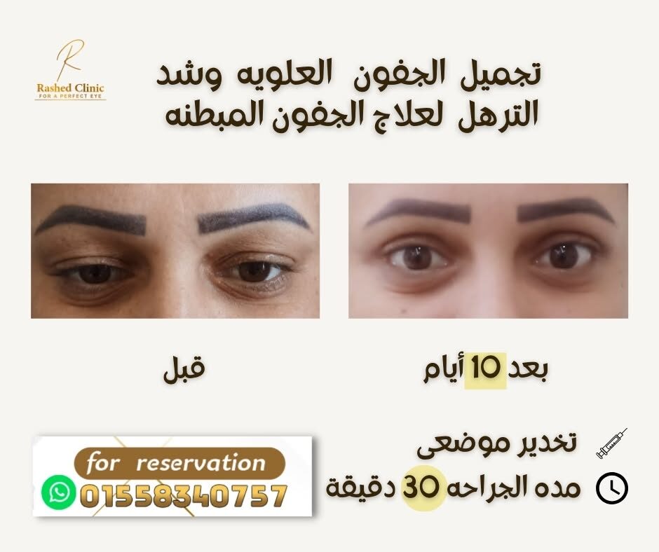 قبل وبعد: رفع الجفن العلوي