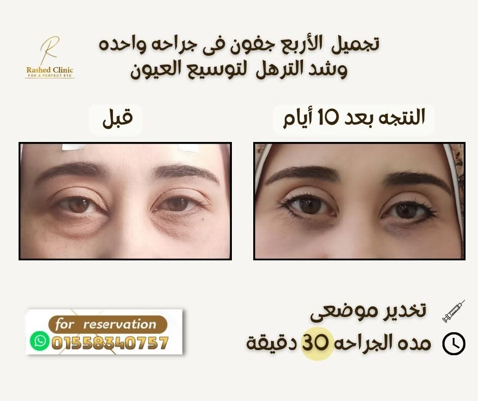 قبل وبعد: تجميل الجفون الأربعة